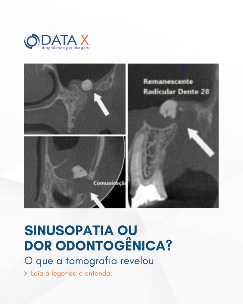 sinusopatia-ou-dor-odontogenica