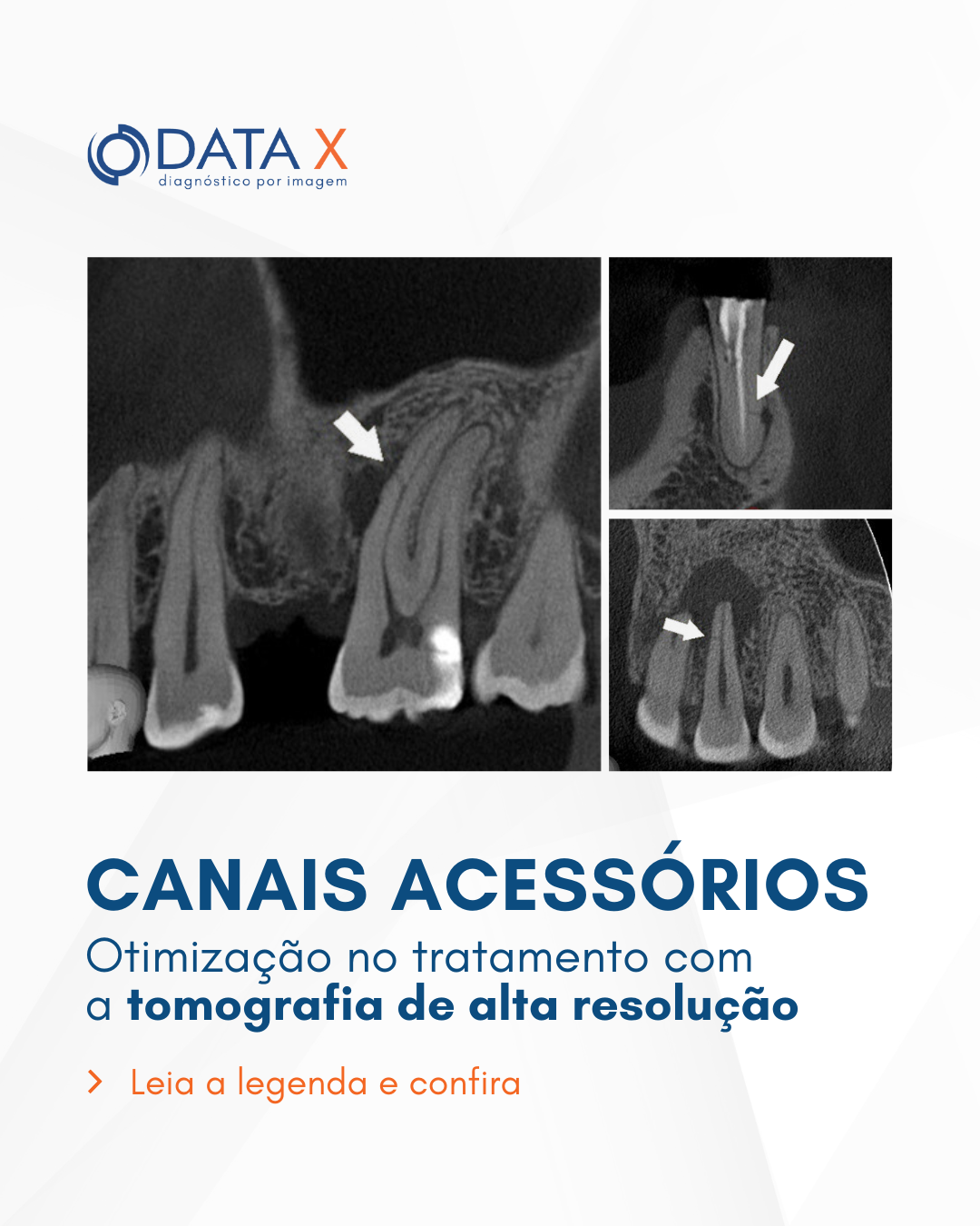 canais-acessorios