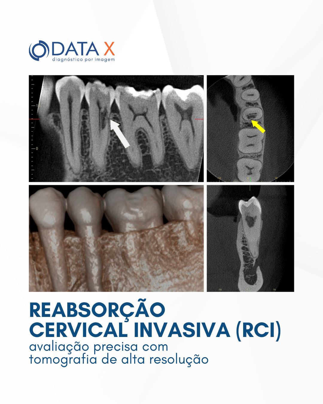 reabsorcao-cervical-invasiva-rci
