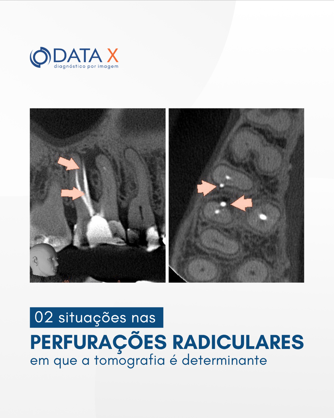 2-situacoes-nas-perfuracoes-radiculares