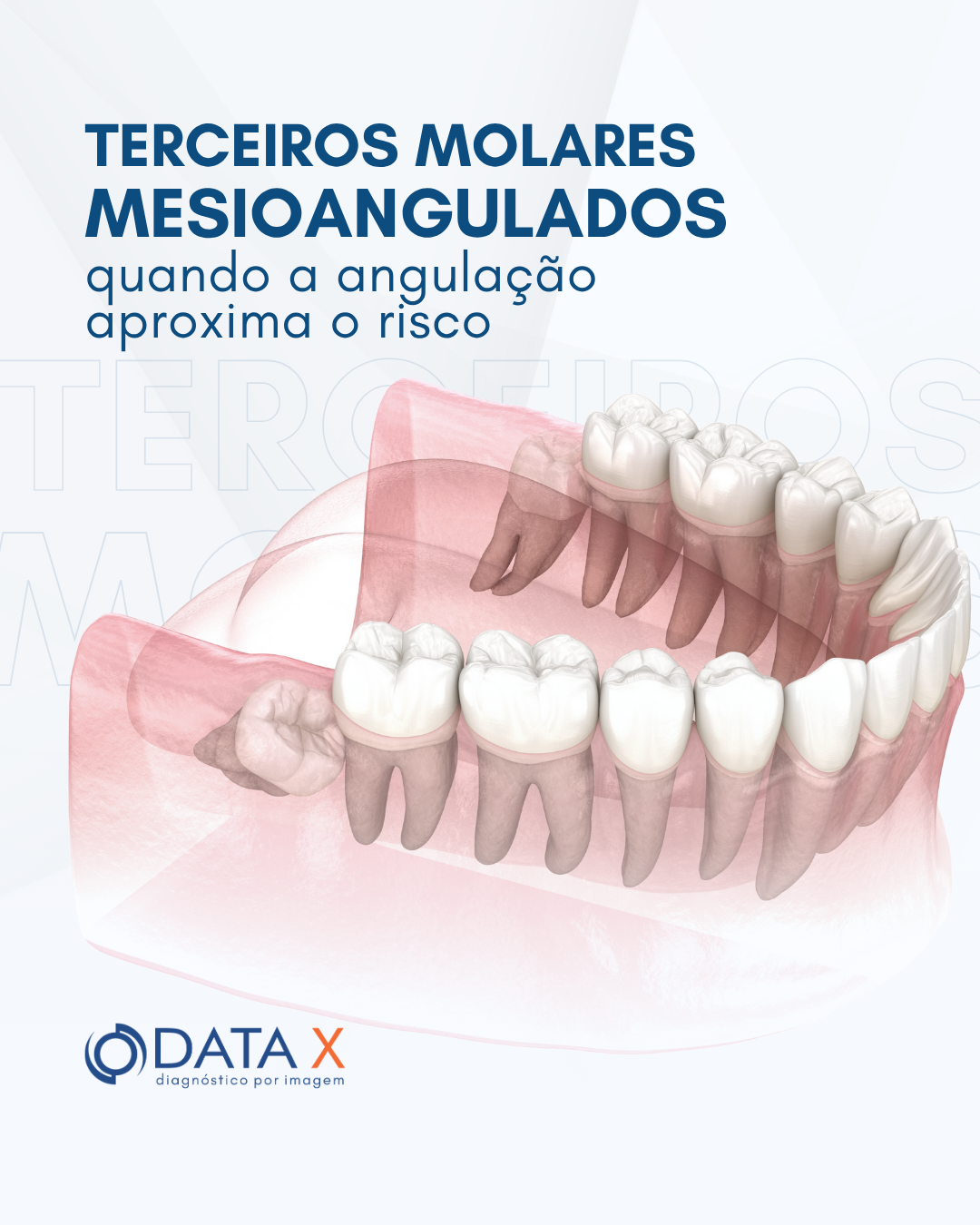 terceiros-molares-mesioangulados
