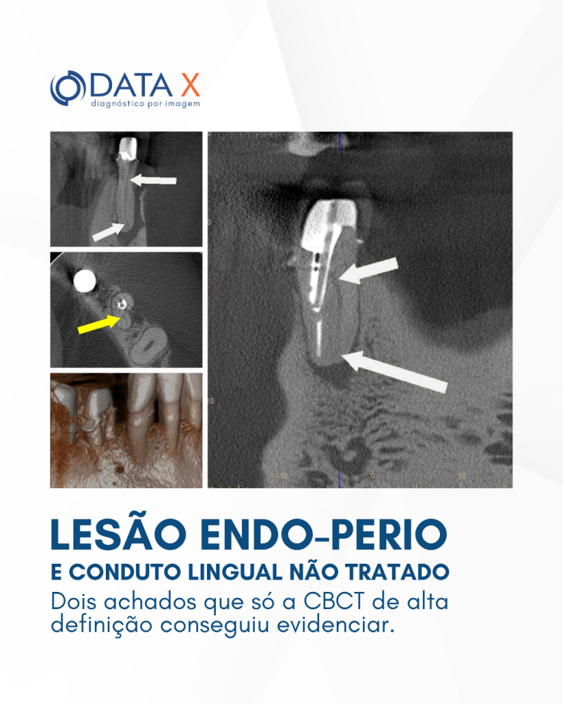 lesao-endo-perio-e-conduto-lingual-nao-tratado
